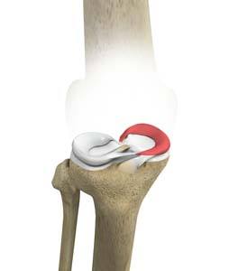 Medial Meniscus Syndrome pic
