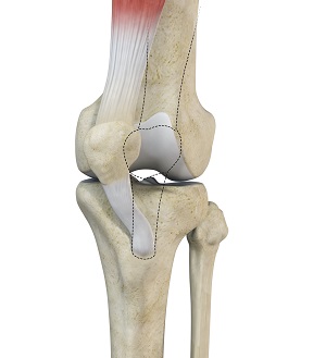 Medial Patellar Instability pic