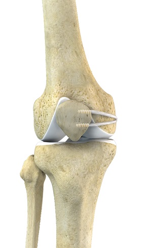 Medial Patellofemoral Ligament (MPFL) Tears pic