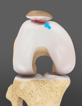 Patellofemoral Arthritis pic
