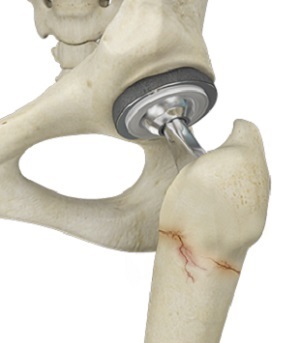 Periprosthetic Knee Fractures pic