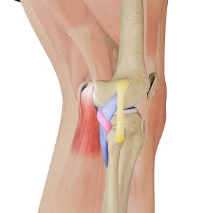 Posterolateral Corner Injuries pic