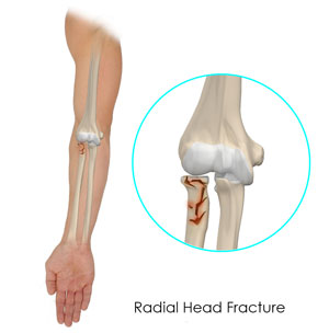 Radial Head Fractures of the Elbow pic