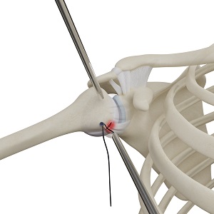 Repair of Humeral Ligamentous Tears pic