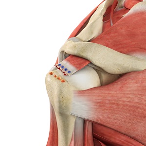 Revision Rotator Cuff Surgery pic