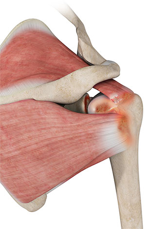 Rotator Cuff Arthropathy pic
