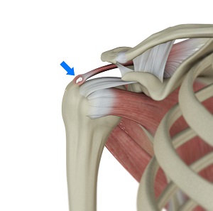 Rotator Cuff Calcification pic