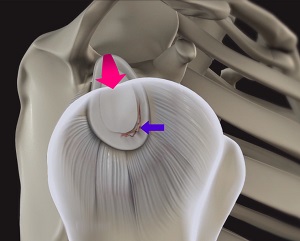 Shoulder Labral Tear with Instability pic