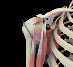 Shoulder Tendonitis pic