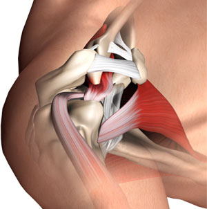 Subacromial Decompression pic