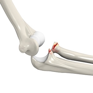 Terrible Triad Injuries pic
