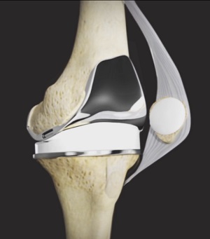 Tricompartmental Knee Replacement pic