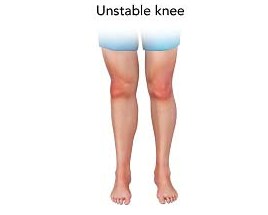 Unstable Knee pic