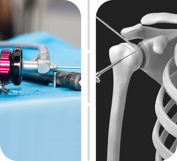 Arthroscopic Joint Surgery