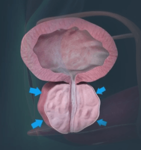 Enlarged Prostate or Benign Prostatic Hypertrophy