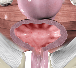 Cystitis