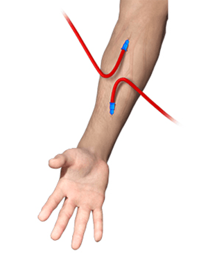Dialysis Access