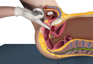Digital Rectal Examination