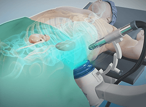 Extracorporeal Shock Wave Lithotripsy (ESWL)