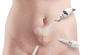 Hernia Repair