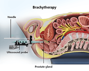 High Dose Rate Brachytherapy