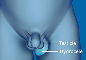 Hydrocele Repair