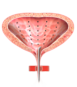 Intravesicular Botox for Overactive Bladder