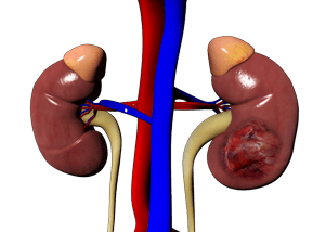 Kidney Cancer