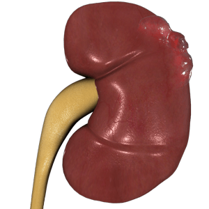 Simple Kidney Cysts