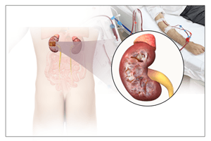 Kidney Failure and Dialysis
