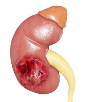 Kidney Tumor