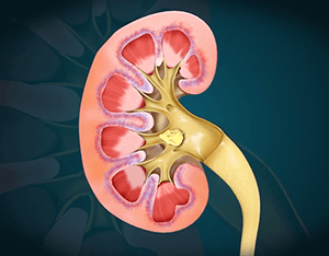 Laser Treatment of Kidney Stones