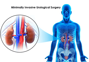 Minimally Invasive Urological Surgery