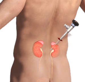 Nephrectomy