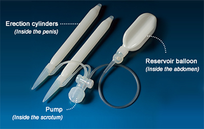 Penile Implant