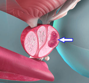 Prostate Cancer Treatment