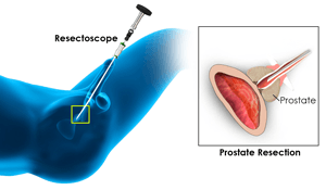 Prostate Resection