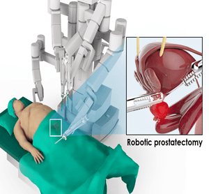 Robotic Prostatectomy