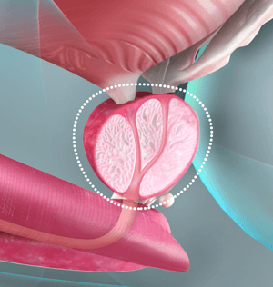Robotic Assisted Laparoscopic Radical Prostatectomy