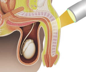 Shockwave Therapy for Erectile Dysfunction