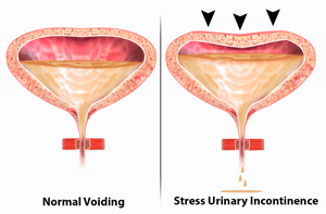 Stress Incontinence
