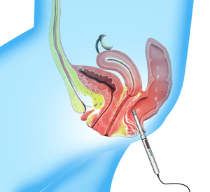 Transrectal Ultrasound
