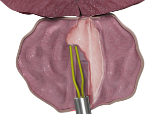 Transurethral Resection of the Prostate (TURP)