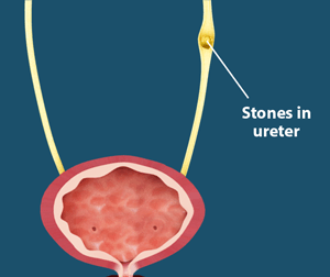 Ureteric Stones