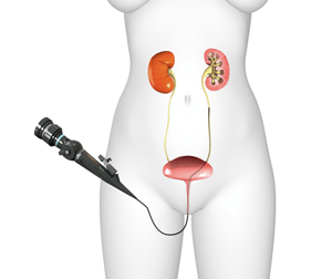 Ureteroscopy