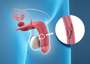 Urethral Cancer