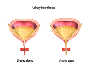 Urinary Incontinence