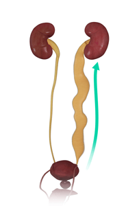 Urinary Reflux (Vesicoureteral Reflux)