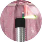 Laser Prostatectomy