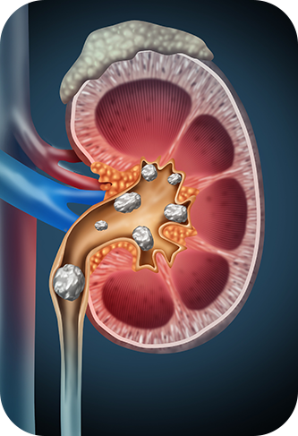 Laser Prostatectomy - Nonsurgical Solutions